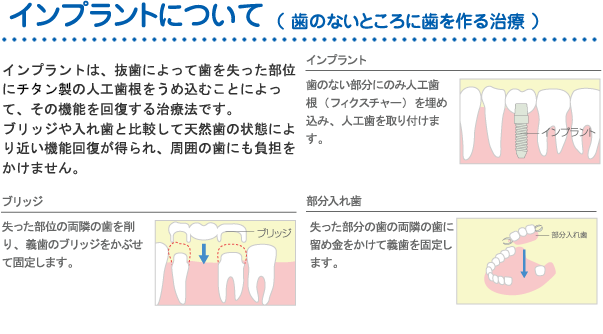 インプラントについて
