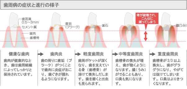 歯周病の症状と進行の様子