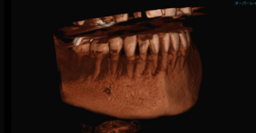 3次元診断（歯科用CT）写真