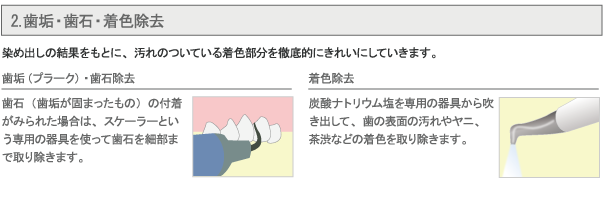 2.歯垢・歯石・着色除去